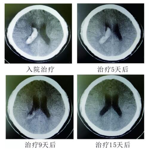 脑出血你不得不引起重视的疾病！！！