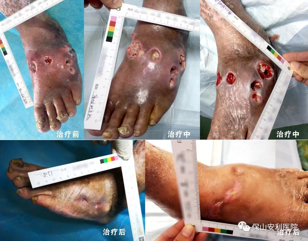 痛风脚面创口6个“洞”经创面负压联合自体富血小板凝胶治疗痊愈