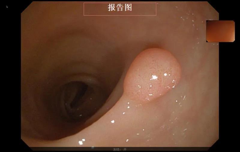 保山安利医院成功开展内镜下消化道息肉高频电切除术