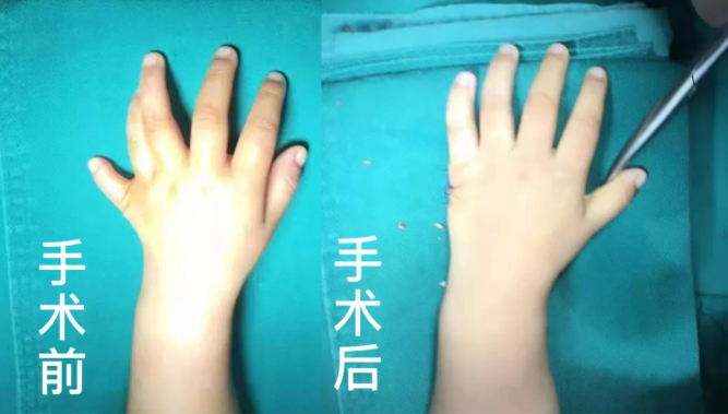 【保山安利医院】2岁小儿手、足多指（趾）成功修复(矫正）！