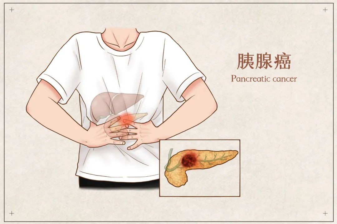 【保山安利医院】“世界胰腺癌日”预防胰腺炎别让它