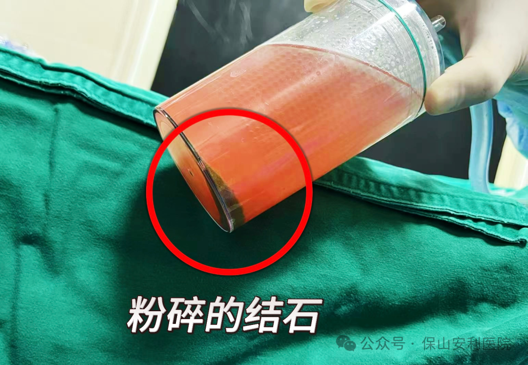 科普丨泌尿结石“克星”钬激光碎石术，手术动图揭秘全过程！